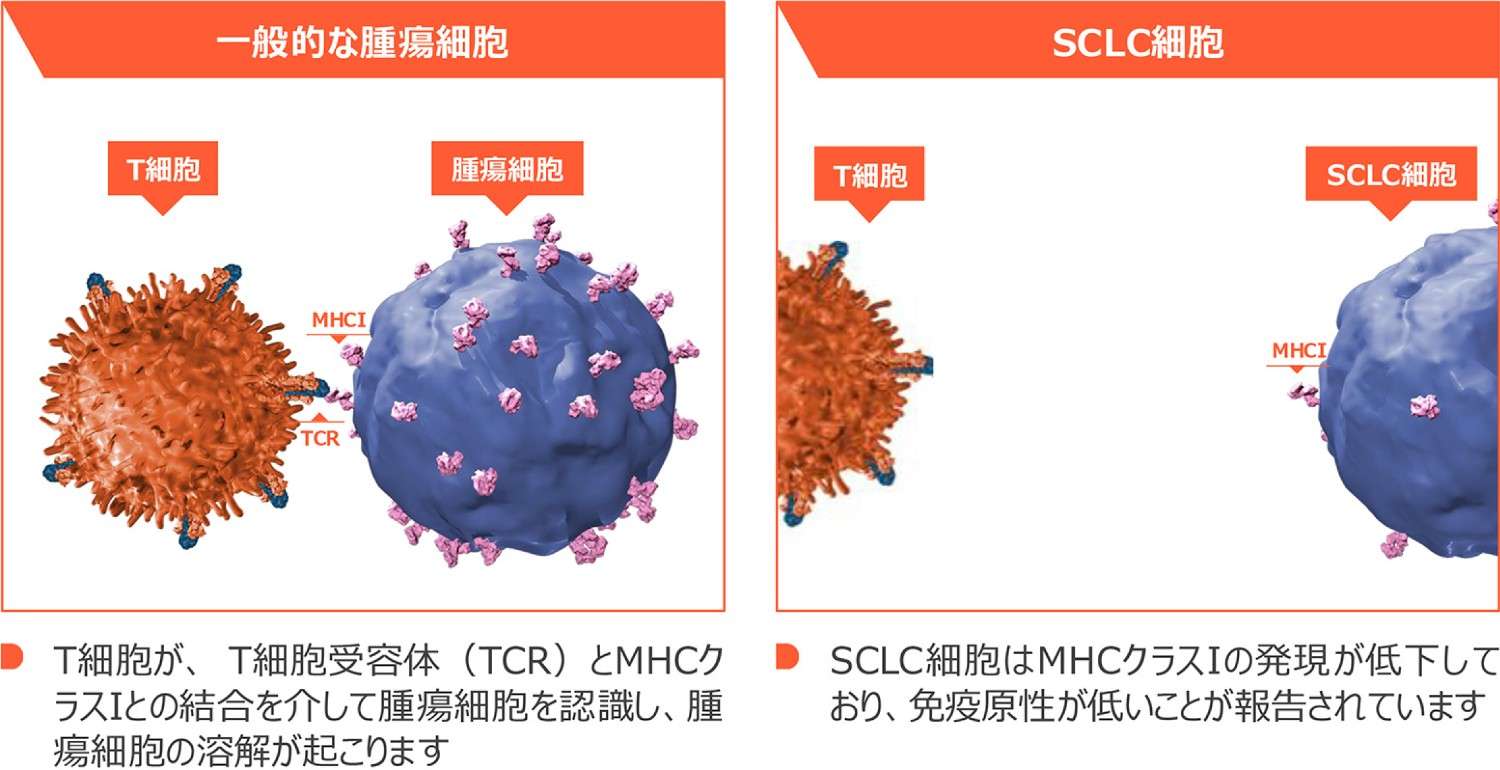 図5 小細胞肺癌におけるMHCクラスⅠの発現低下