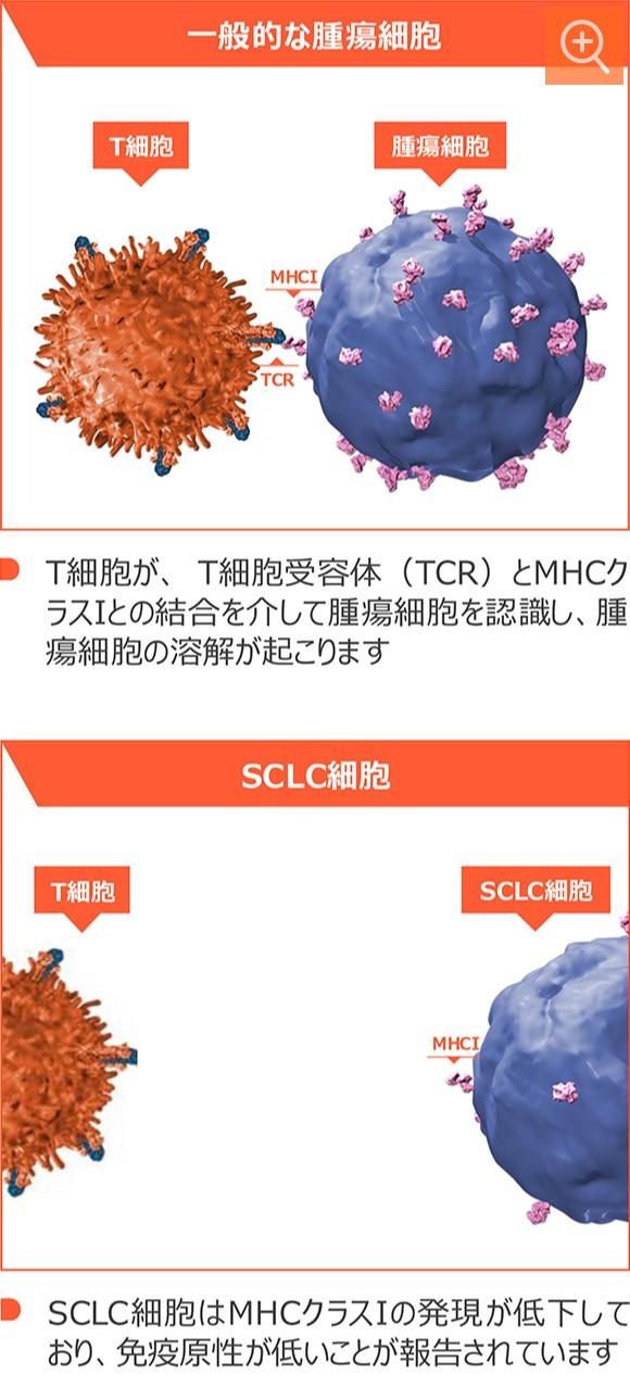 図5 小細胞肺癌におけるMHCクラスⅠの発現低下